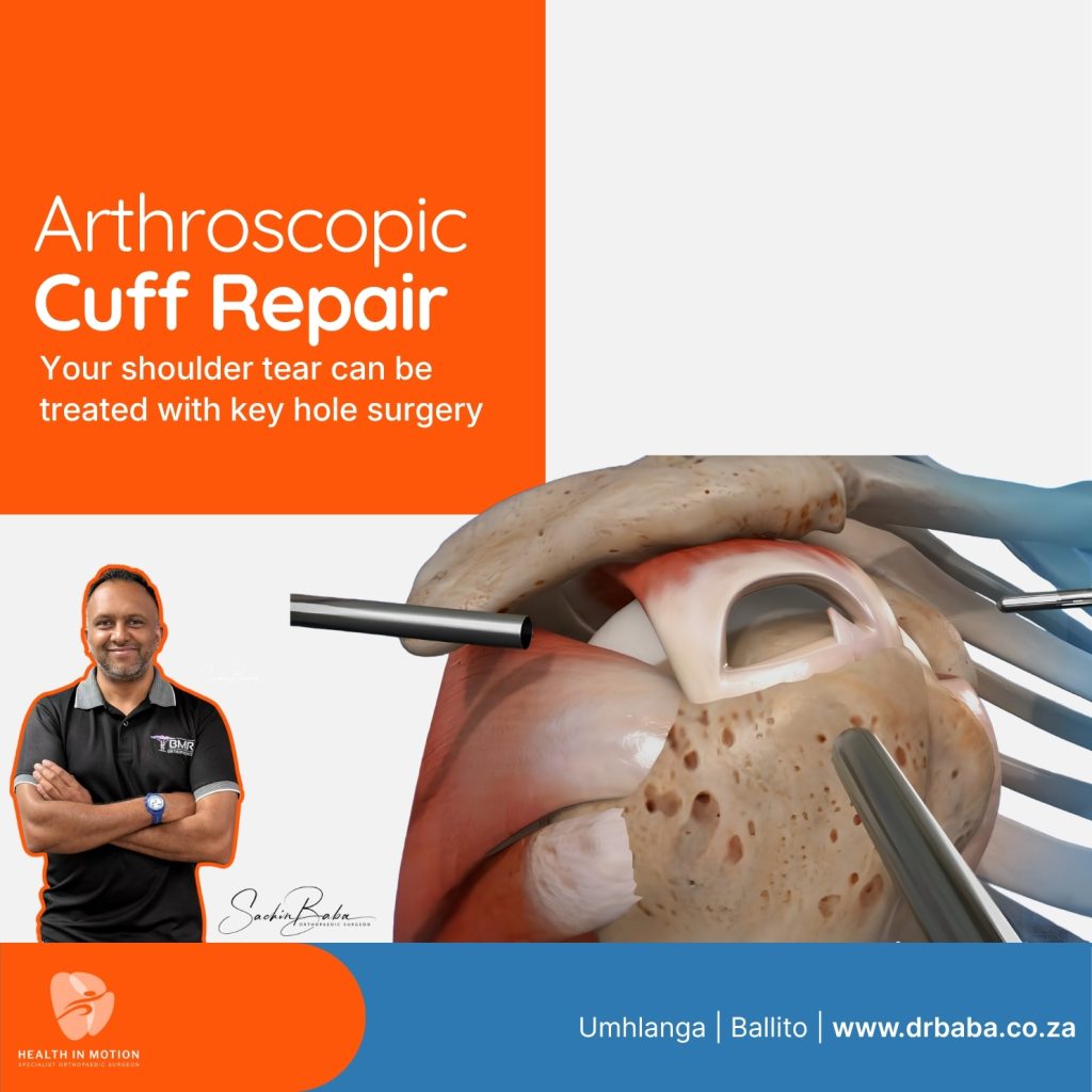 Arthroscopic Cuff Repair